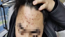 治疗反复痤疮，国壮明秀分院有妙招！